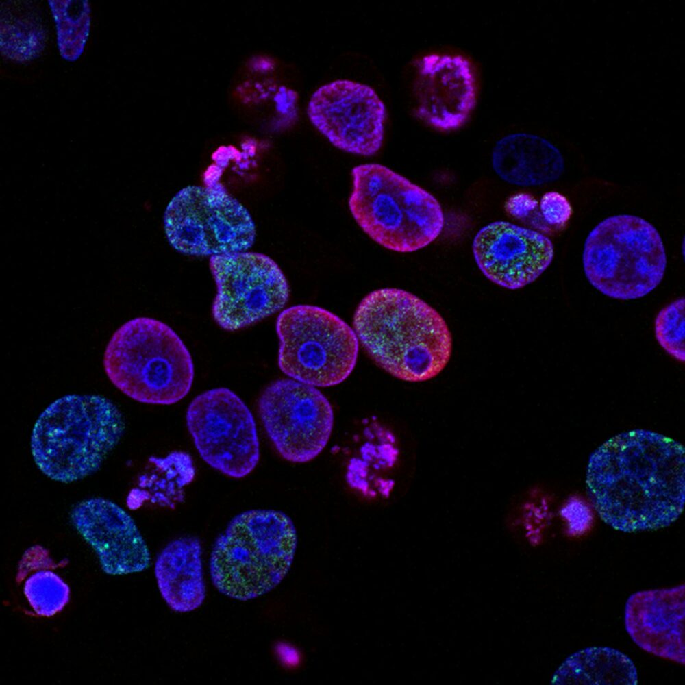 Image shows cancerous cells on a black background.