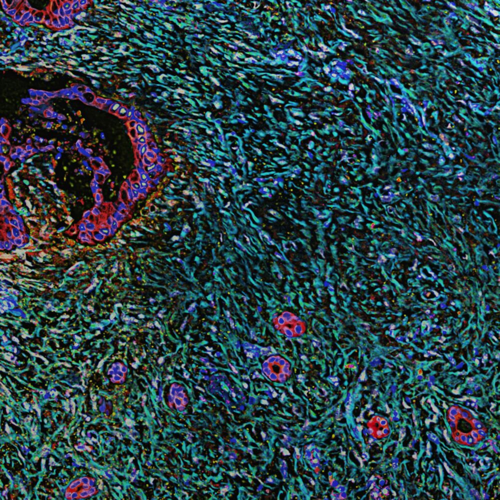 Pancreatic Desmoplasia. Photo by Unsplash National Cancer Institute