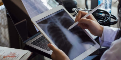 Picture discovery platform detection of lung cancer